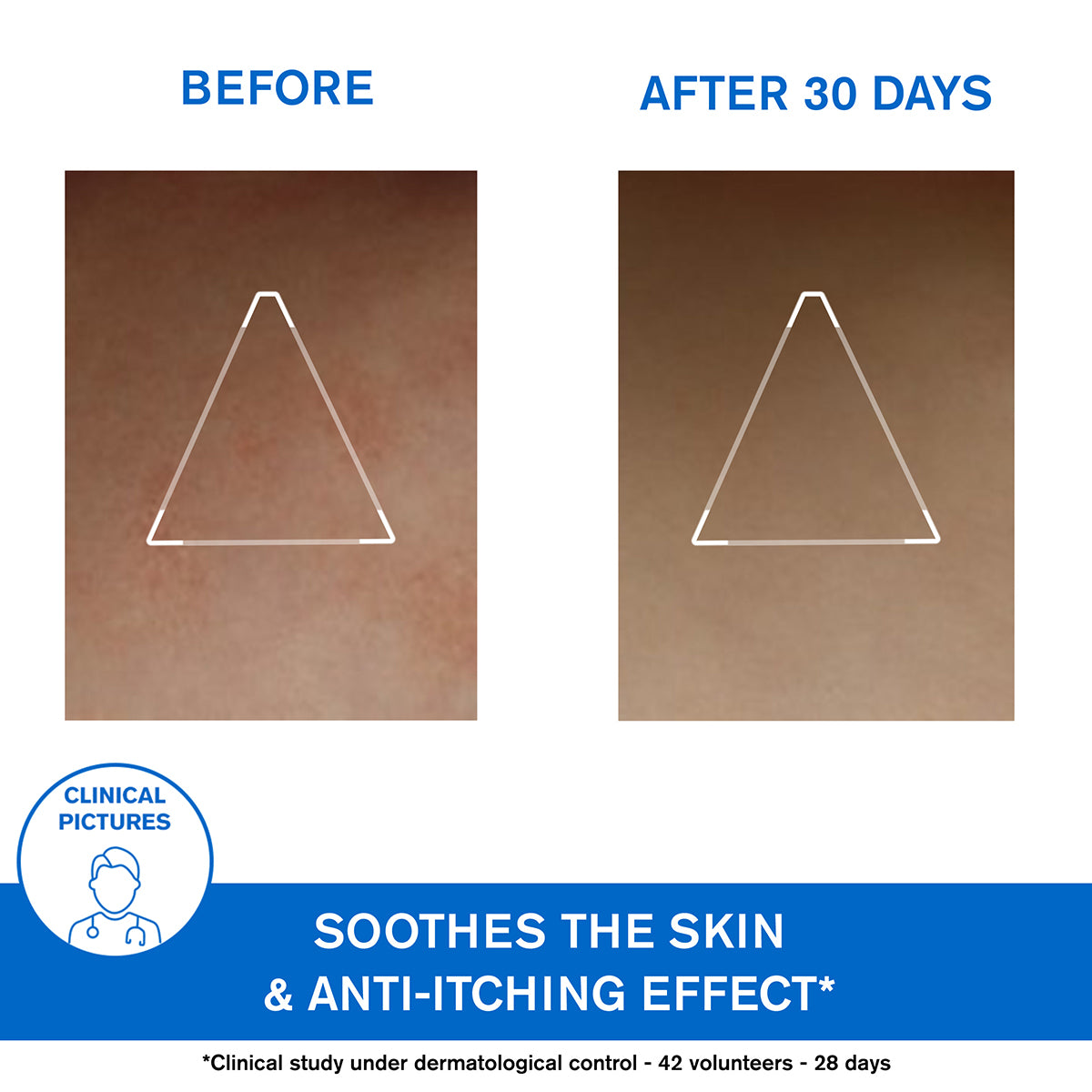 (Medical) Uriage Xemose Lipid-Replenishing Anti-Irritation Cerat 200ml